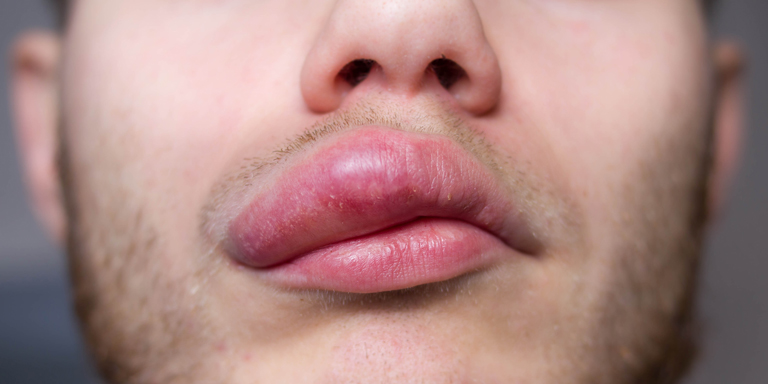 L'angio-œdème se manifeste souvent par un gonflement des lèvres, que l'on voit ici chez un homme.