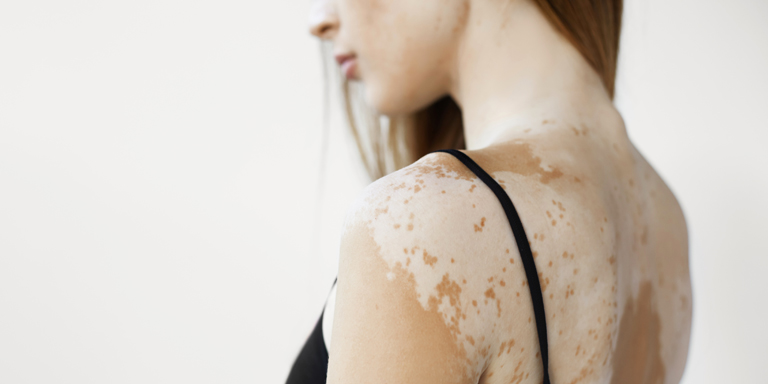 Naked shoulder area of a woman with the white patches on the skin typical of vitiligo.