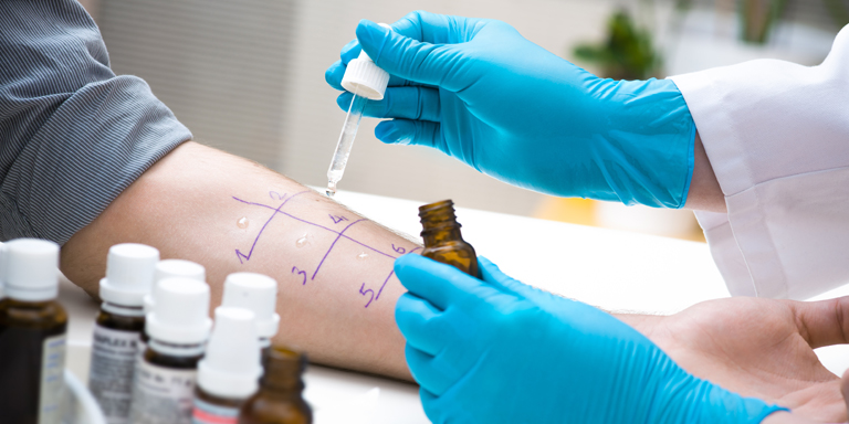 A young woman is being tested for allergens on her arm.