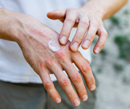 Jahresthema 2020 - Allergien bewegen - Bewegung tut der Haut gut - Mann cremt sich die Hände ein