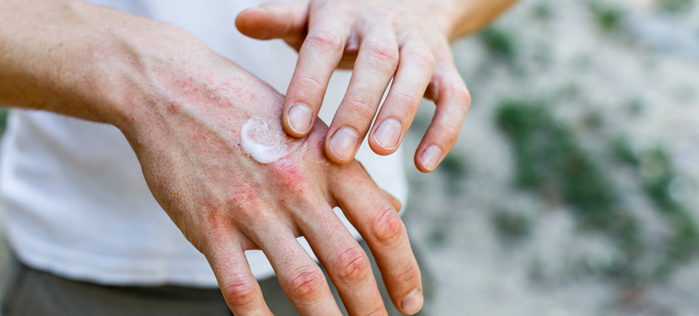 Un uomo si applica la crema sulla mano.