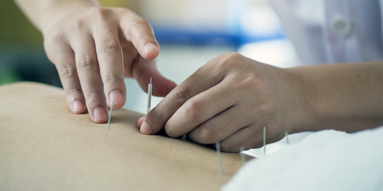 Détail de la photo : les aiguilles d'acupuncture sont placées dans la zone du dos