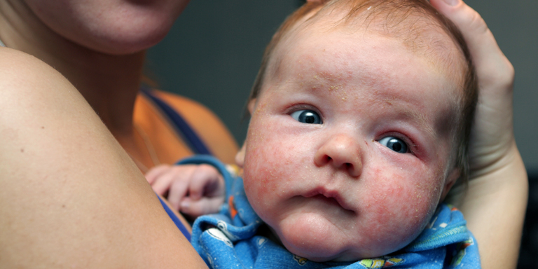 Mother holds her infant, who suffers from severe neurodermatitis, in her arms and supports his head with her hand.