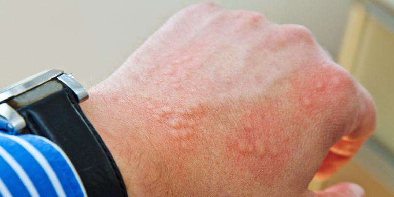 Mano con pustole rossastre tipiche dell'orticaria