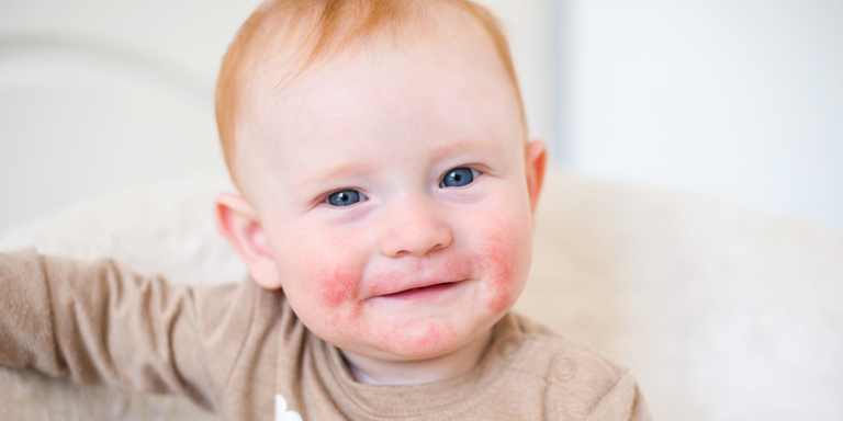 boy with severe neurodermatitis