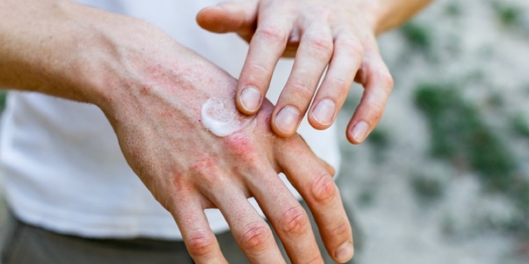 Ein Mann salbt seine Hände mit einer Creme ein