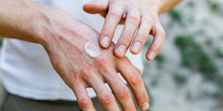 Un homme s'enduit les mains de crème