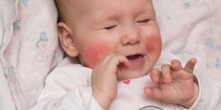 Baby mit Neurodermitis weint